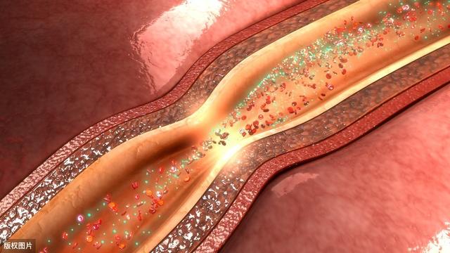 血管内长斑块，会有4表现，若不想脑梗“上身”，做好4点养血管