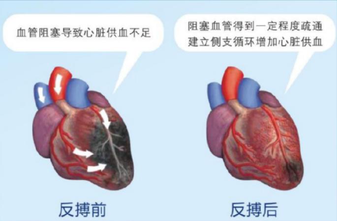 无创体外反搏如何治疗冠心病