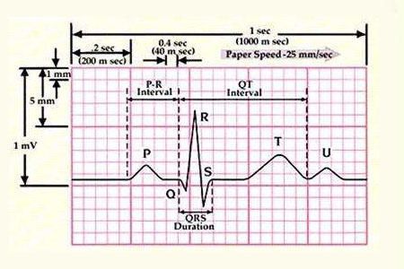 如何看懂心电图？