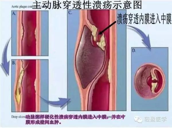 胸痛诊断不容易！