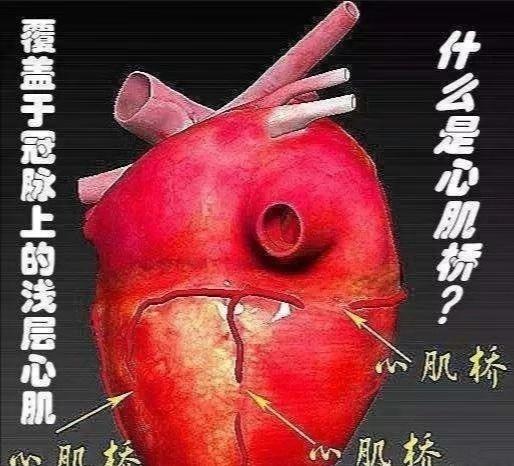 心肌桥是个什么心脏病？也可能引发心肌梗死