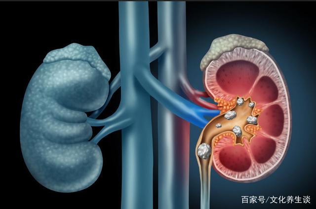 尿酸高可能伤害肾，如果身体出现4个“反常”，请检查尿酸