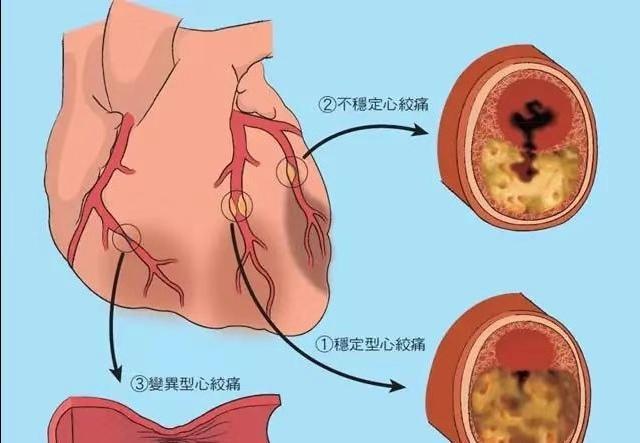 心肌桥是个什么心脏病？也可能引发心肌梗死