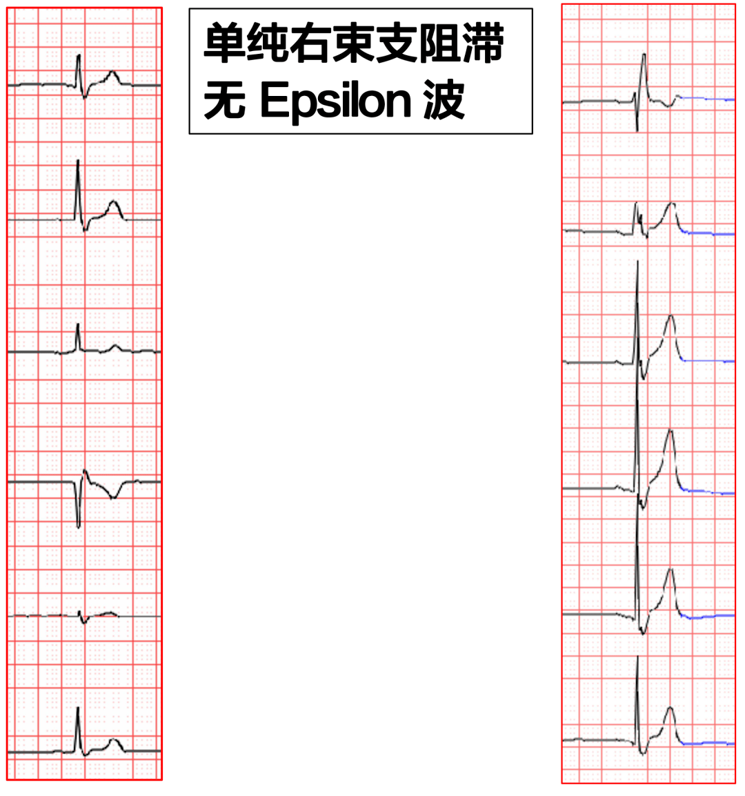 Epsilon 波的识别及临床意义