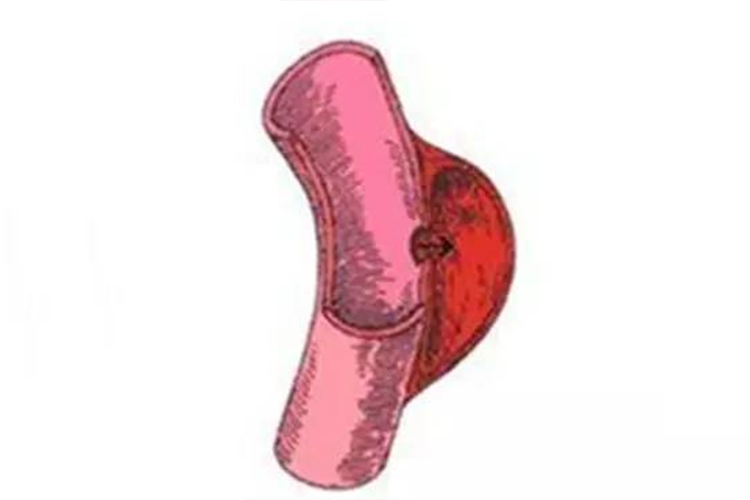 假性动脉瘤位于动脉一侧图